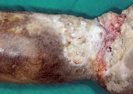 MARJOLIN'S ULCER