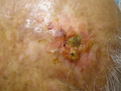 MARJOLIN'S ULCER 