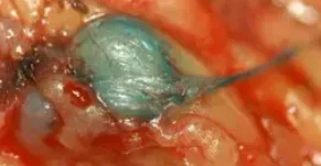 MELANOMA-SENTINEL LYMPH NODE .(Courtesy Dr . V . Penopoulos).