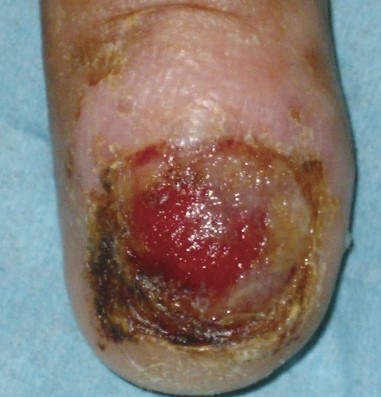 NAIL MELANOMA