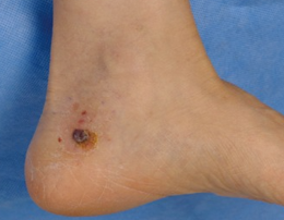NODULAR MELANOMA