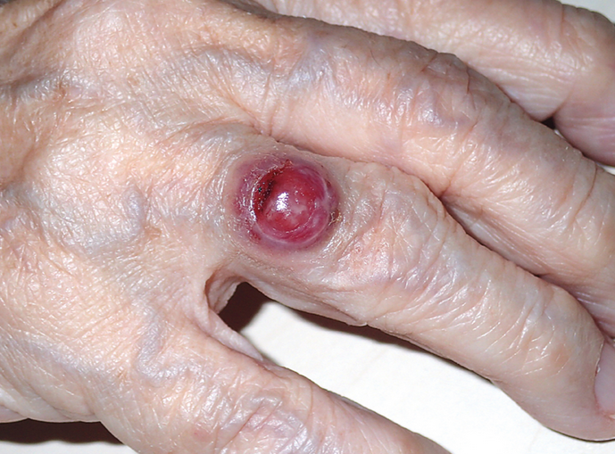 MERKEL CELL CARCINOMA