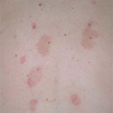MEYERSON NEVUS