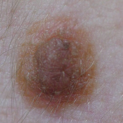 MIXED NEVUS