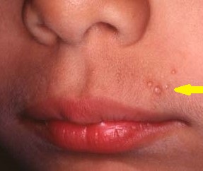 MOLLUSCUM CONTAGIOSUM