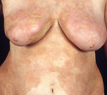 MORFEA SCLERODERMA