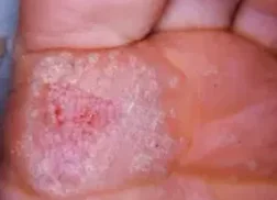 MOSAIC PLANTAR WART