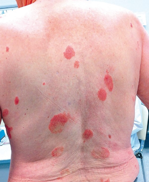 MYCOSIS FUNGOIDES