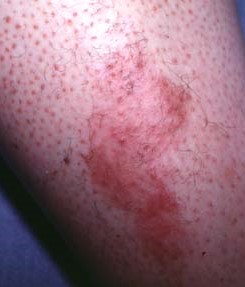 NECROBIOSIS LIPOIDICA DIABETICORUM