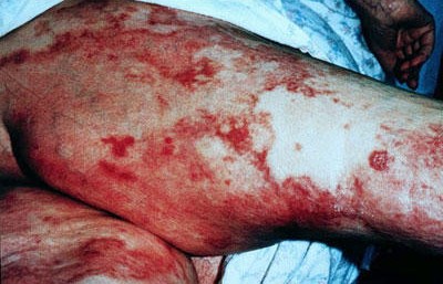 NECROLYTIC MIGRATORY ERYTHEMA