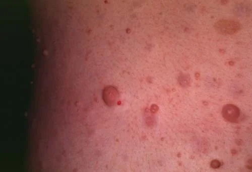 MULTIPLE NEUROFIBROMAS 