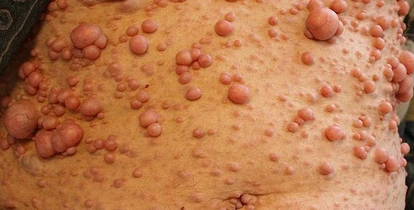 VON RECKLINGHAUSEN NEUROFIBROMATOSIS