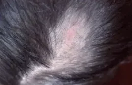 NEVUS SEBACEUS