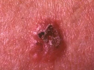 NODULAR BASAL CELL CARCINOMA