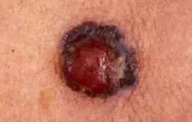 NODULAR MELANOMA1
