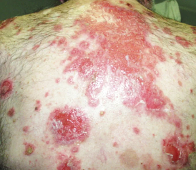 PEMPHIGUS VULGARIS