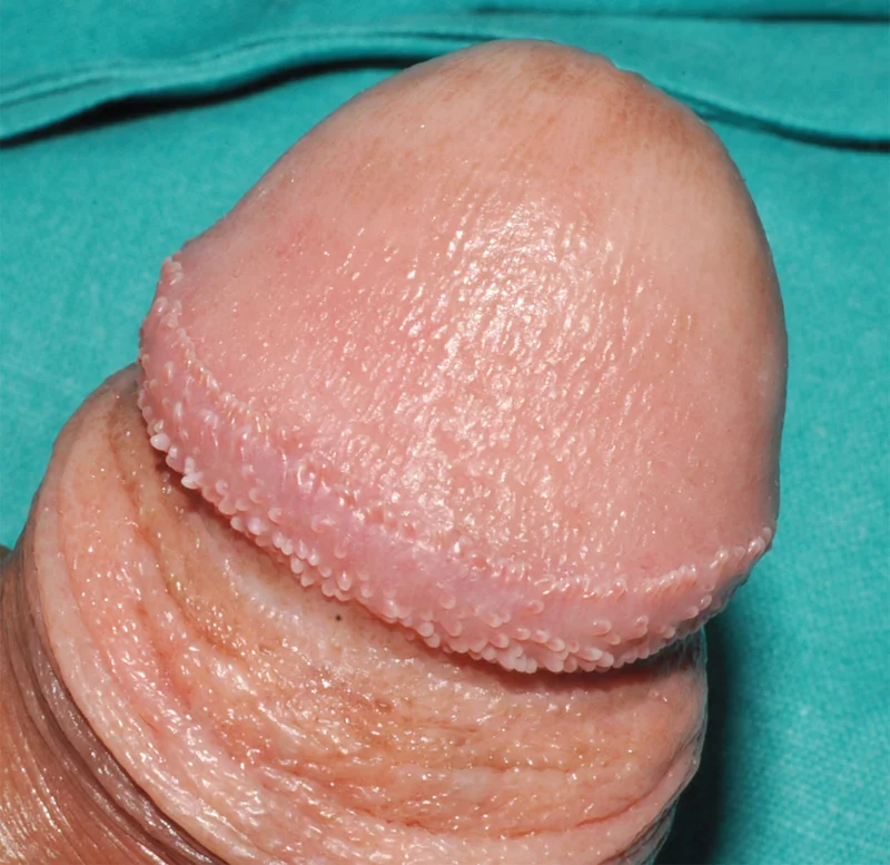 PENILE PAPULES