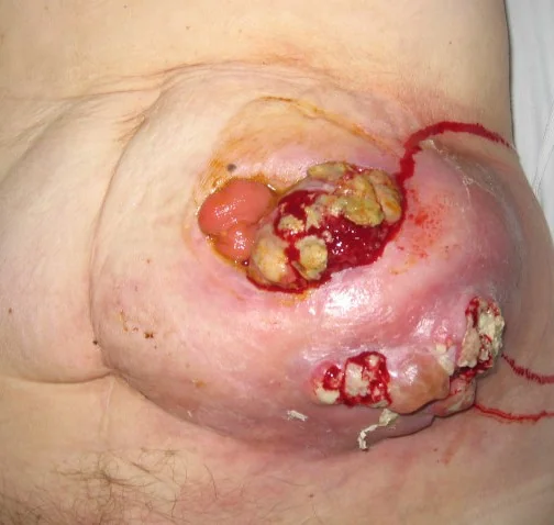 PERISTOMAL CUTANEOUS METASTASIS