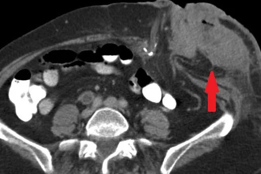 PERISTOMAL CUTANEOUS METASTASIS