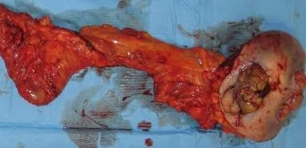PERISTOMAL CUTANEOUS METASTASIS