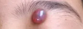 PILOMATRIXOMA