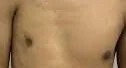 POLAND SYNDROME