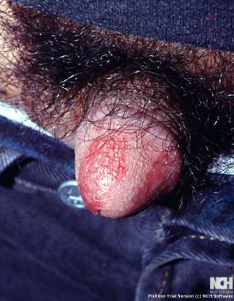 PSORIASIS 
