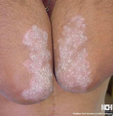 PSORIASIS