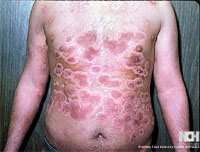 PSORIASIS