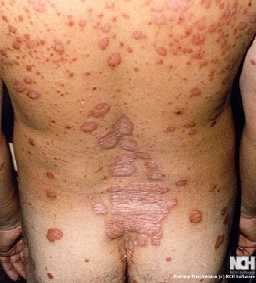 PSORIASIS 