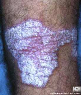 PSORIASIS 