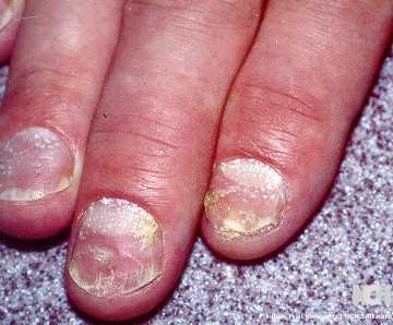 NAIL PSORIASIS