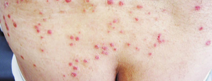 PSORIATIC FLARE