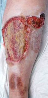 PYODERMA GANGRENOSUM