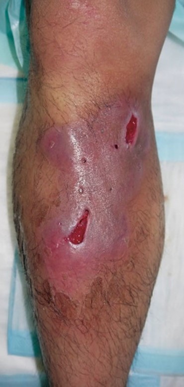 PYODERMA GANGRENOSUM