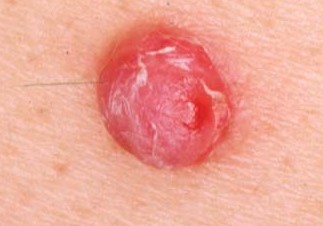 PYOGENIC GRANULOMA