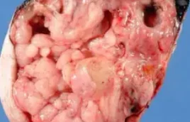 SACROCOCCYGEAL TERATOMA