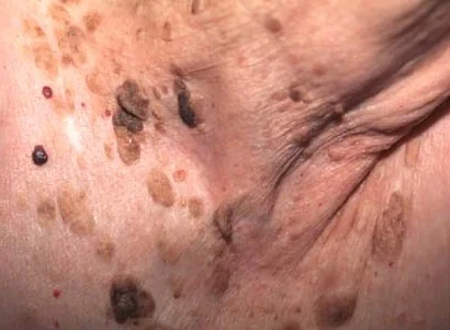 SEBORRHEIC KERATOSIS