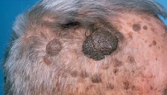 SEBORRHEIC KERATOSIS