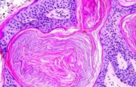 SEBORRHEIC KERATOSIS 