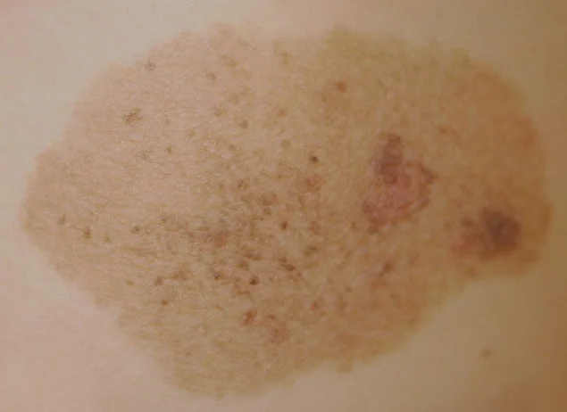 SPECKLED NEVUS