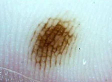 ACRAL NEVUS