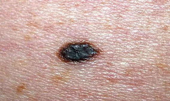 LENTIGO