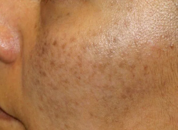 ITO NEVUS