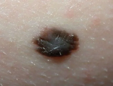 REED NEVUS