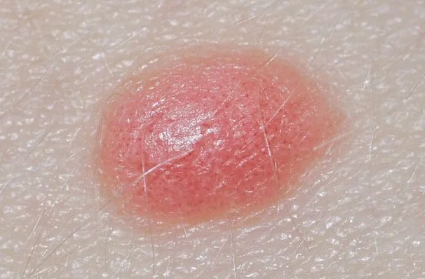 SPITZ NEVUS