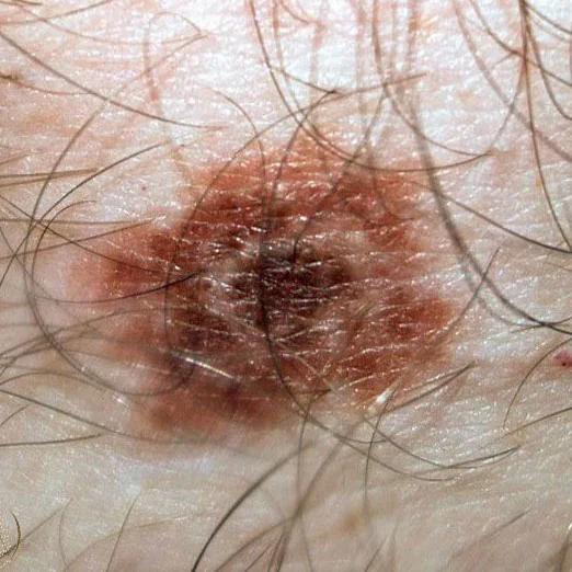 TARGET NEVUS
