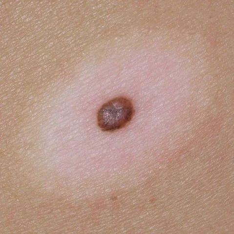 SUTTON NEVUS