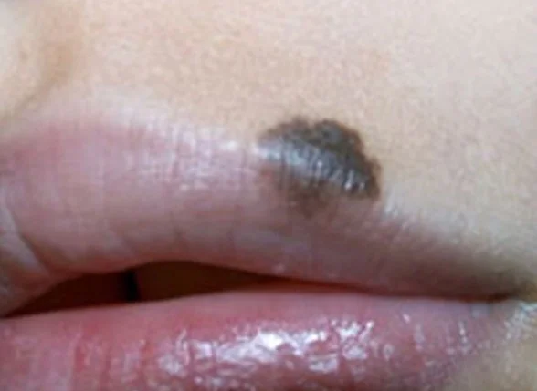 LABIAL NEVUS