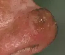 SQUAMOUS CELL CARCINOMA